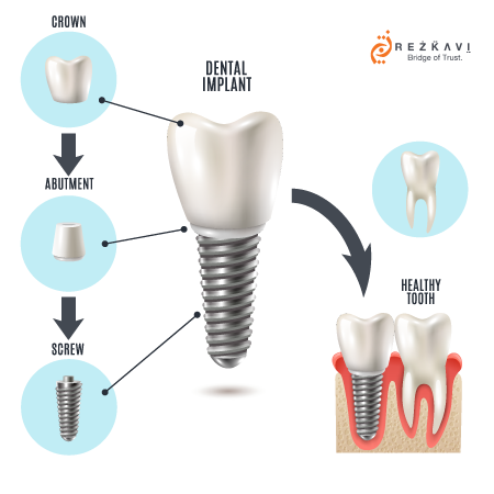 implant tedavisi