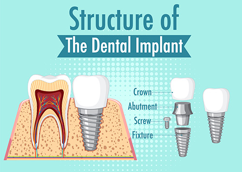 dental implant in turkey