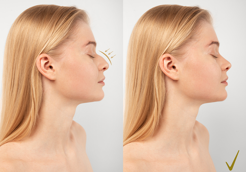 Rhinoplasty