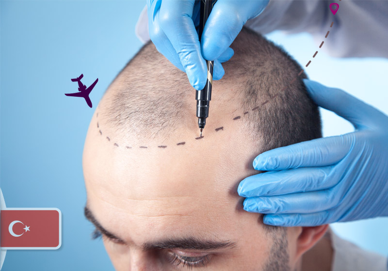 Hair Transplant in Turkey