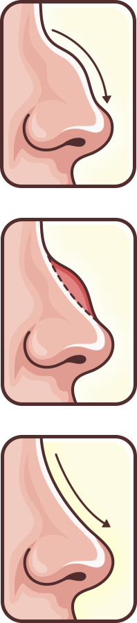 Rhinoplasty in Turkey