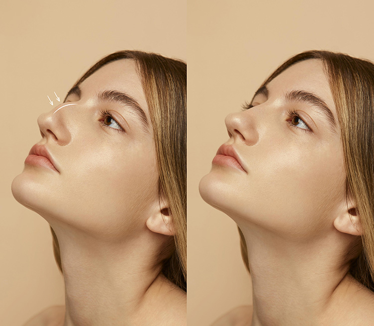 Rhinoplasty (Nose Aesthetics)