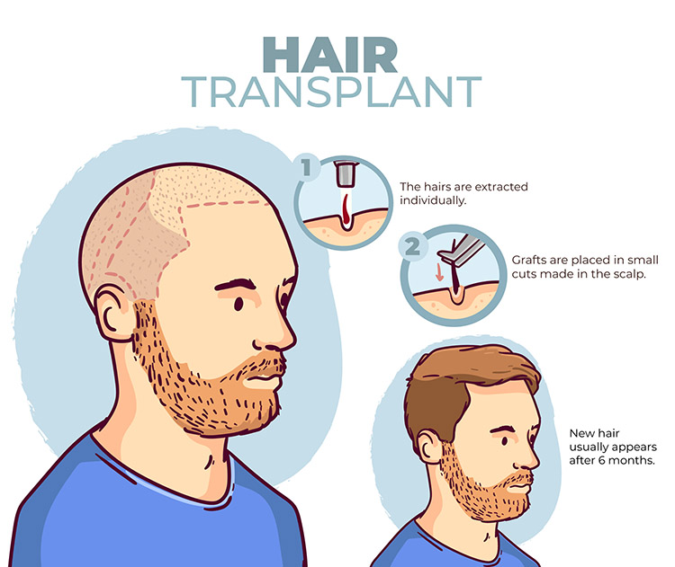 hair transplant fue