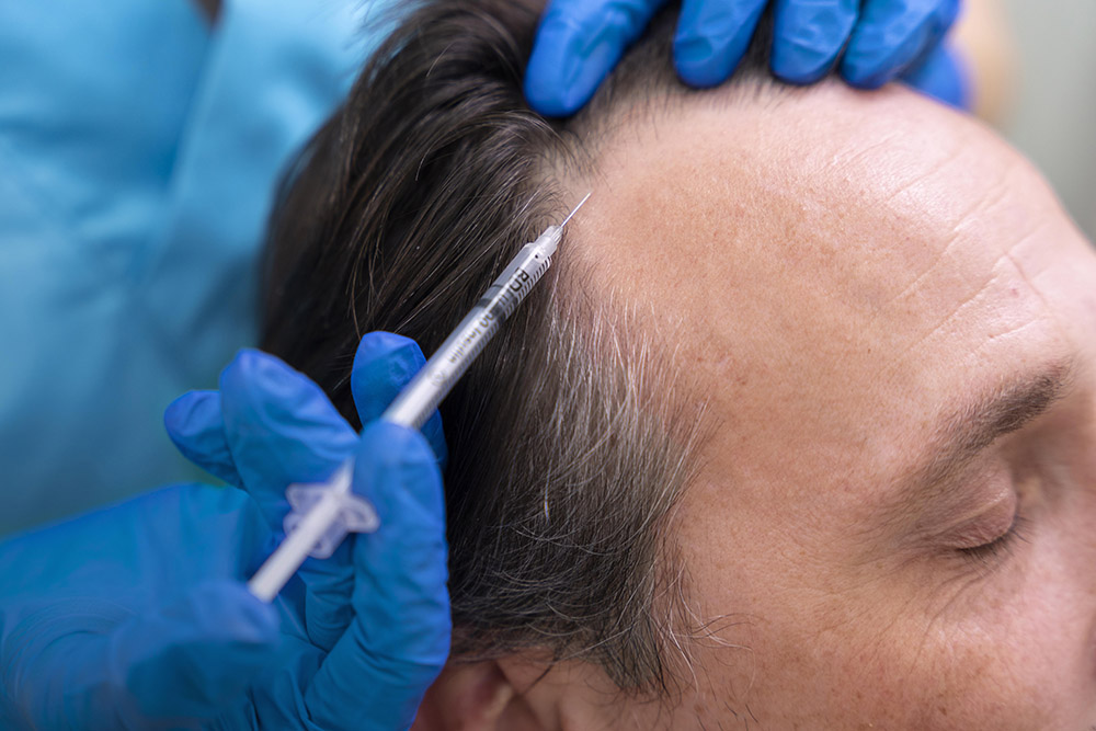 Fue-Haartransplantation